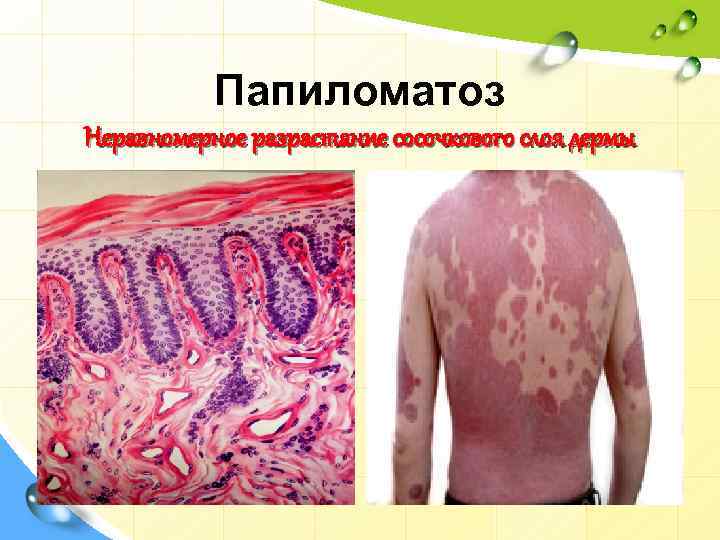 Папиломатоз Неравномерное разрастание сосочкового слоя дермы 