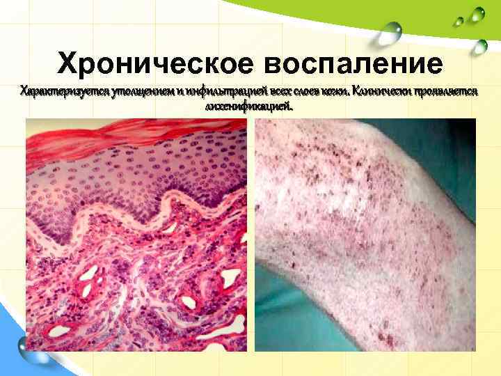 Хроническое воспаление Характеризуется утолщением и инфильтрацией всех слоев кожи. Клинически проявляется лихенификацией. 