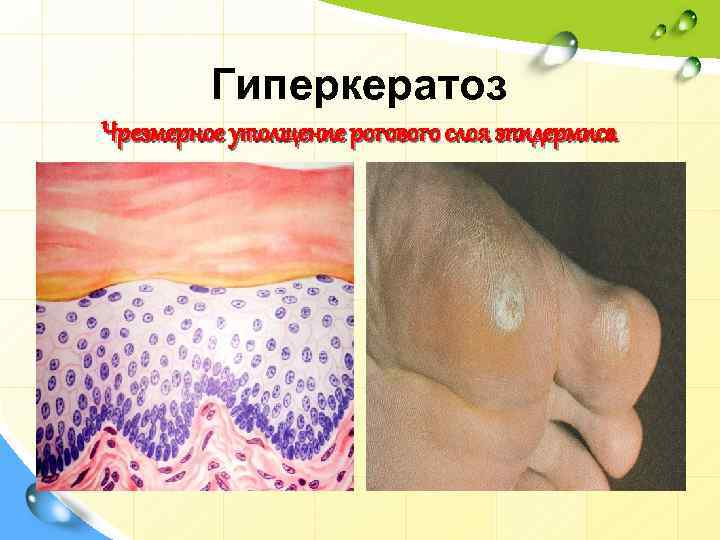 Гиперкератоз Чрезмерное утолщение рогового слоя эпидермиса 