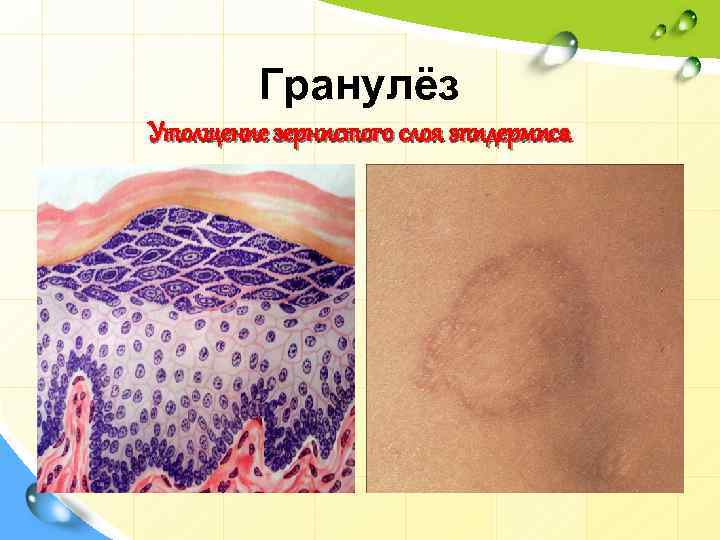 Гранулёз Утолщение зернистого слоя эпидермиса 