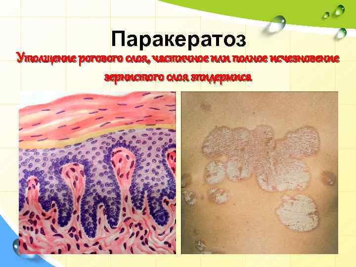 Паракератоз Утолщение рогового слоя, частичное или полное исчезновение зернистого слоя эпидермиса 