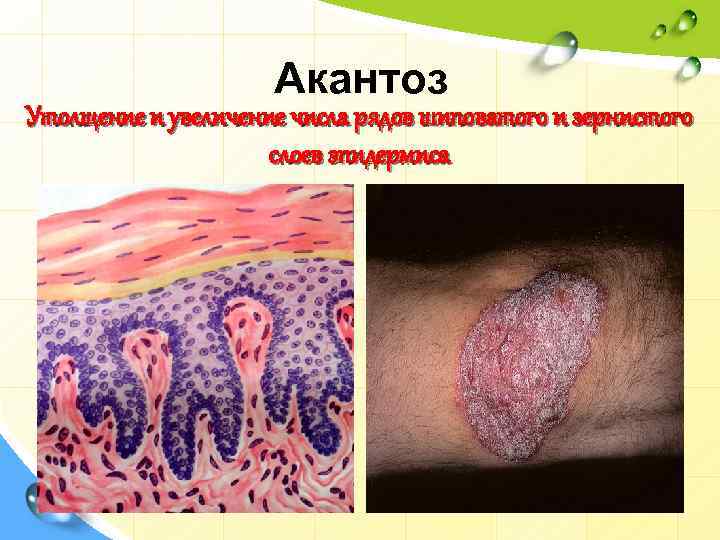 Акантоз Утолщение и увеличение числа рядов шиповатого и зернистого слоев эпидермиса 