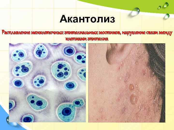 Акантолиз Расплавление межклеточных эпителиальных мостиков, нарушение связи между клетками эпителия 
