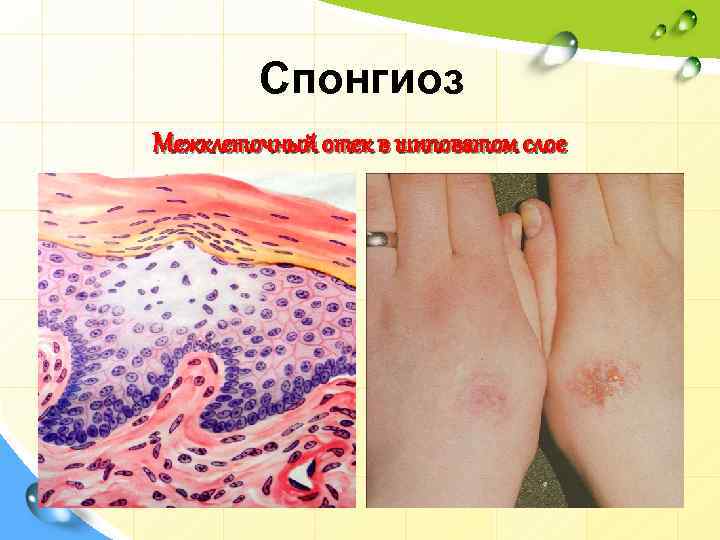 Спонгиоз Межклеточный отек в шиповатом слое 