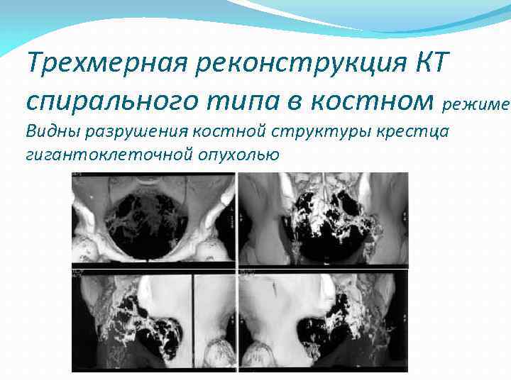 Трехмерная реконструкция КТ спирального типа в костном режиме. Видны разрушения костной структуры крестца гигантоклеточной