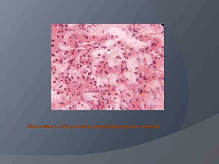 Комплексы атипичных эозинофильных клеток 