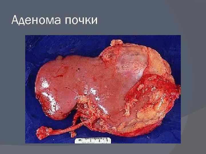 Аденома почки 