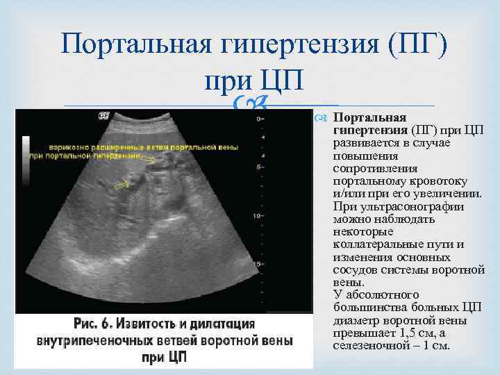 Портальная гипертензия (ПГ) при ЦП развивается в случае повышения сопротивления портальному кровотоку и/или при