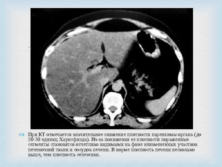  При КТ отмечается значительное снижение плотности паренхимы органа (до 20 -30 единиц Хаунсфилда).