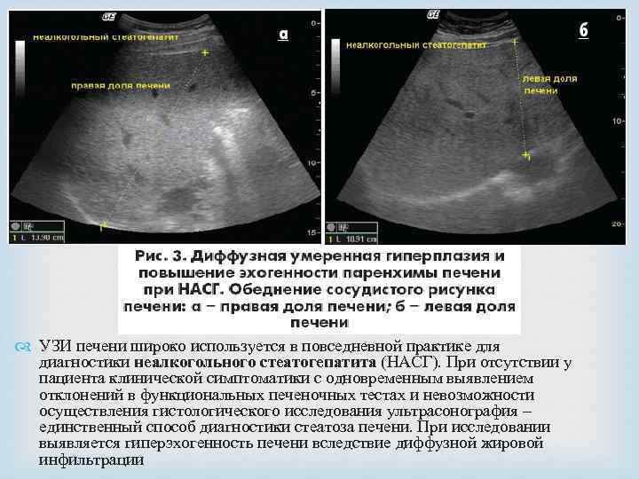  УЗИ печени широко используется в повседневной практике для диагностики неалкогольного стеатогепатита (НАСГ). При