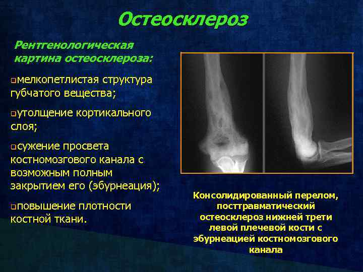 Остеосклероз Рентгенологическая картина остеосклероза: мелкопетлистая структура губчатого вещества; q утолщение кортикального слоя; q сужение