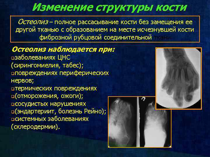 Изменение структуры кости Остеолиз – полное рассасывание кости без замещения ее другой тканью с