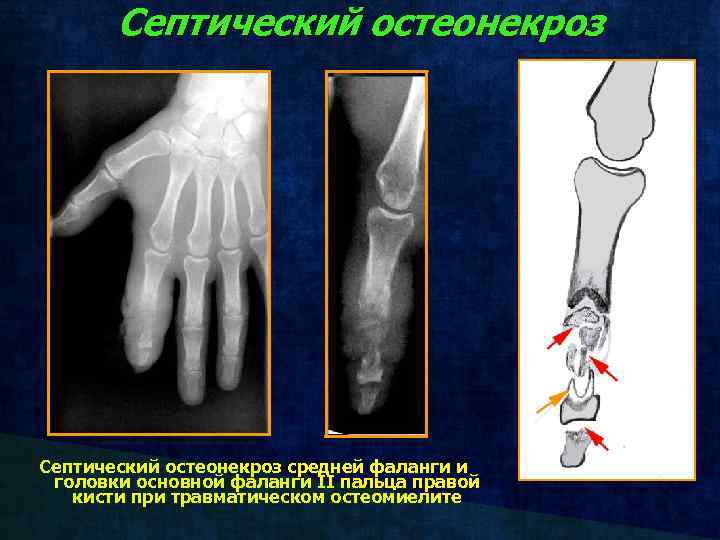 Септический остеонекроз средней фаланги и головки основной фаланги II пальца правой кисти при травматическом