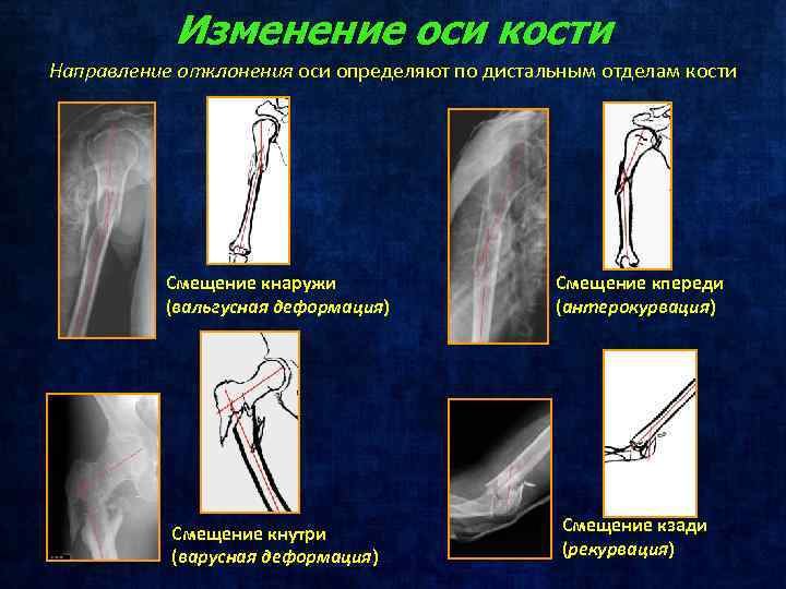 Изменение оси кости Направление отклонения оси определяют по дистальным отделам кости Смещение кнаружи (вальгусная