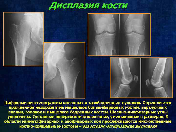 Дисплазия кости Цифровые рентгенограммы коленных и тазобедренных суставов. Определяется врожденное недоразвитие мыщелков большеберцовых костей,