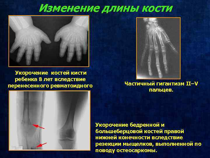 Изменение длины кости Укорочение костей кисти ребенка 8 лет вследствие перенесенного ревматоидного артрита. Частичный