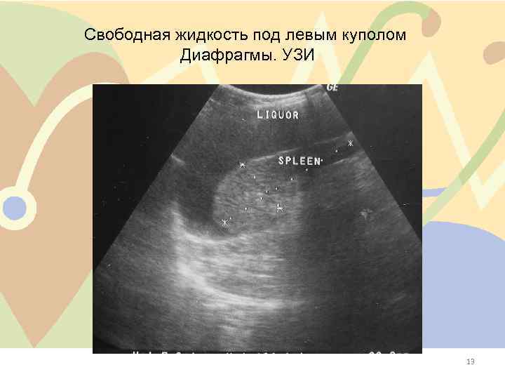 Свободная жидкость под левым куполом Диафрагмы. УЗИ 13 