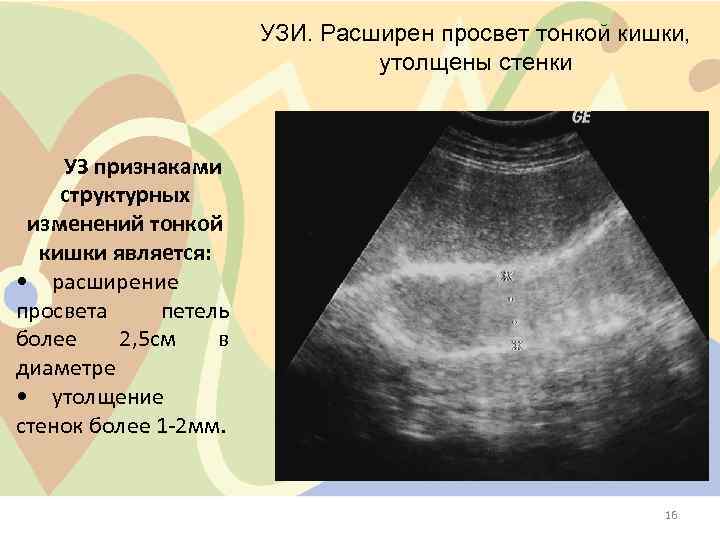 УЗИ. Расширен просвет тонкой кишки, утолщены стенки УЗ признаками структурных изменений тонкой кишки является: