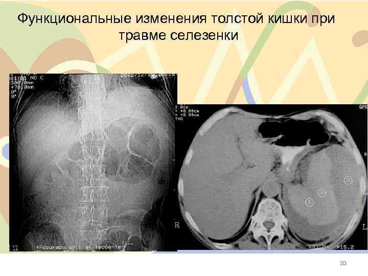 Функциональные изменения толстой кишки при травме селезенки 20 