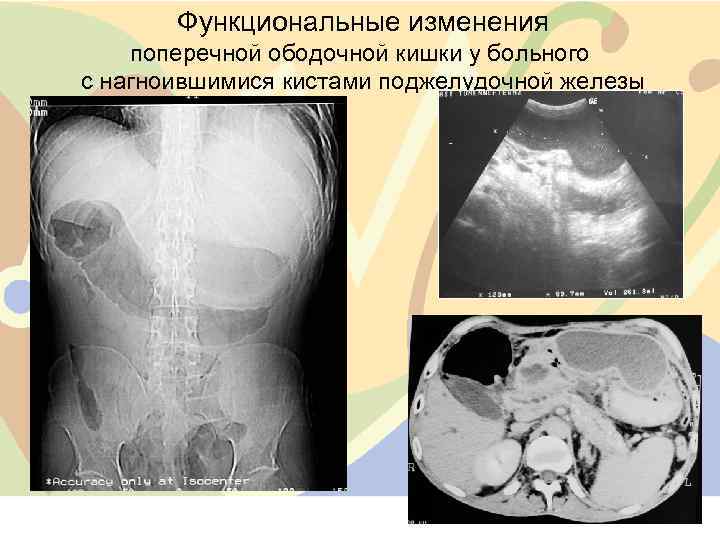 Функциональные изменения поперечной ободочной кишки у больного с нагноившимися кистами поджелудочной железы 22 