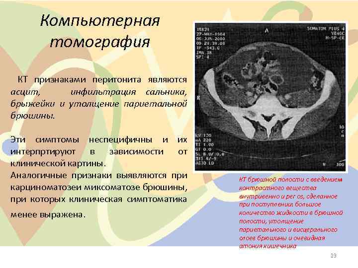 Компьютерная томография КТ признаками перитонита являются асцит, инфильтрация сальника, брыжейки и утолщение париетальной брюшины.