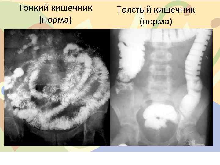 Тонкий кишечник (норма) Толстый кишечник (норма) 