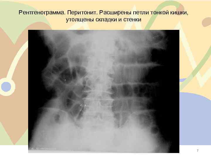Рентгенограмма. Перитонит. Расширены петли тонкой кишки, утолщены складки и стенки 7 