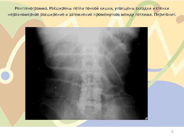 Рентгенограмма. Расширены петли тонкой кишки, утолщены складки и стенки неравномерное расширение и затемнение промежутков