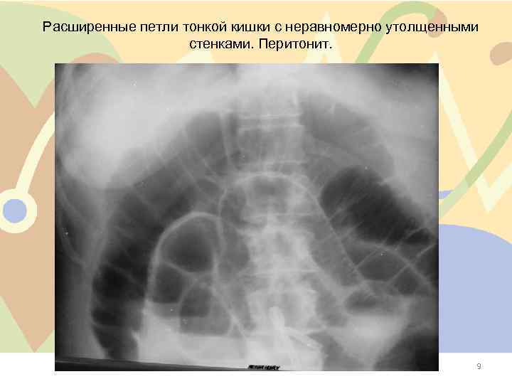 Расширенные петли тонкой кишки с неравномерно утолщенными стенками. Перитонит. 9 