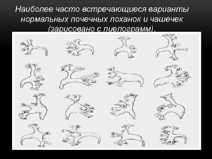 Наиболее часто встречающиеся варианты нормальных почечных лоханок и чашечек (зарисовано с пиелограмм). 