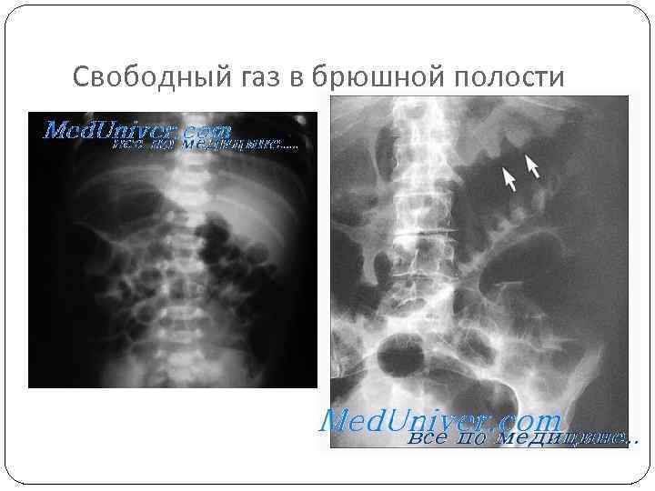 Свободный газ в брюшной полости 