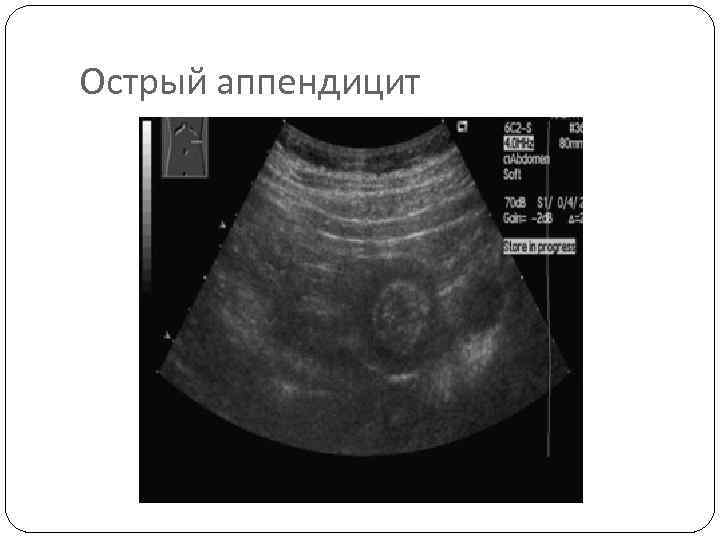 Острый аппендицит 