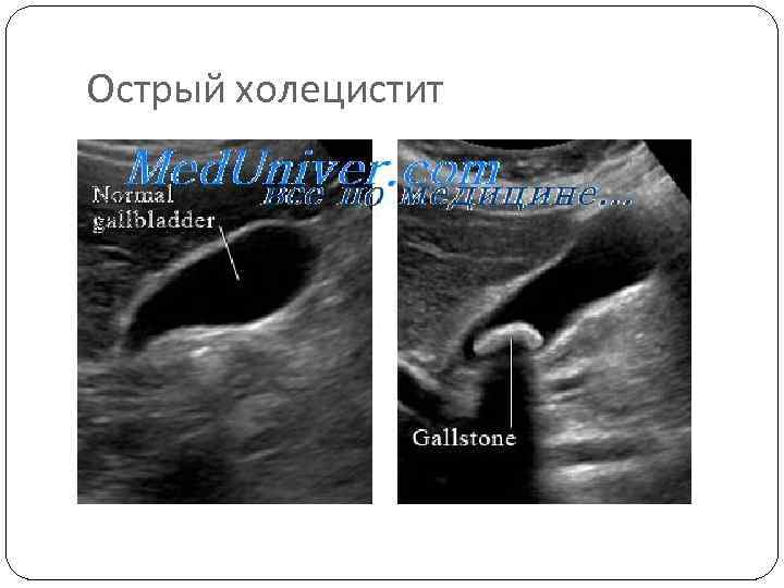 Острый холецистит 