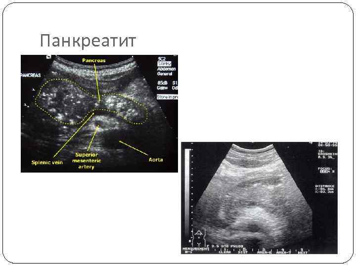 Панкреатит 