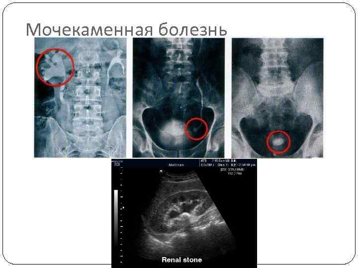 Мочекаменная болезнь 