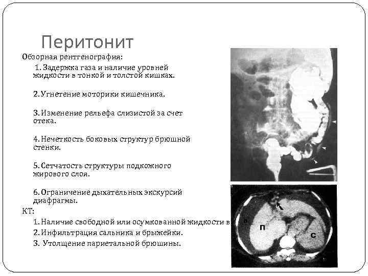 Перитонит Обзорная рентгенография: 1. Задержка газа и наличие уровней жидкости в тонкой и толстой