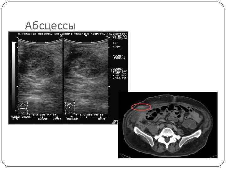 Абсцессы 