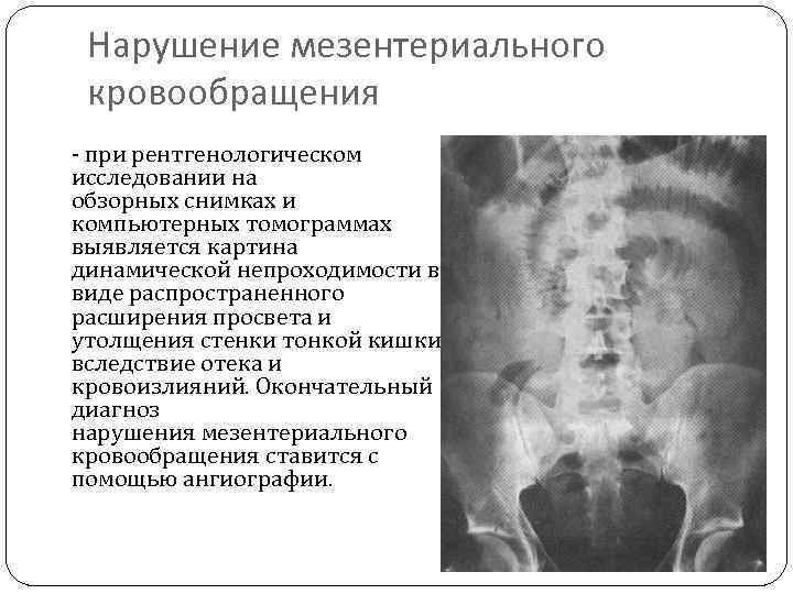 Нарушение мезентериального кровообращения - при рентгенологическом исследовании на обзорных снимках и компьютерных томограммах выявляется