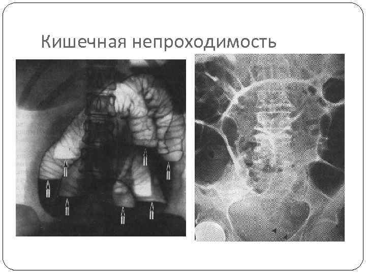 Кишечная непроходимость 