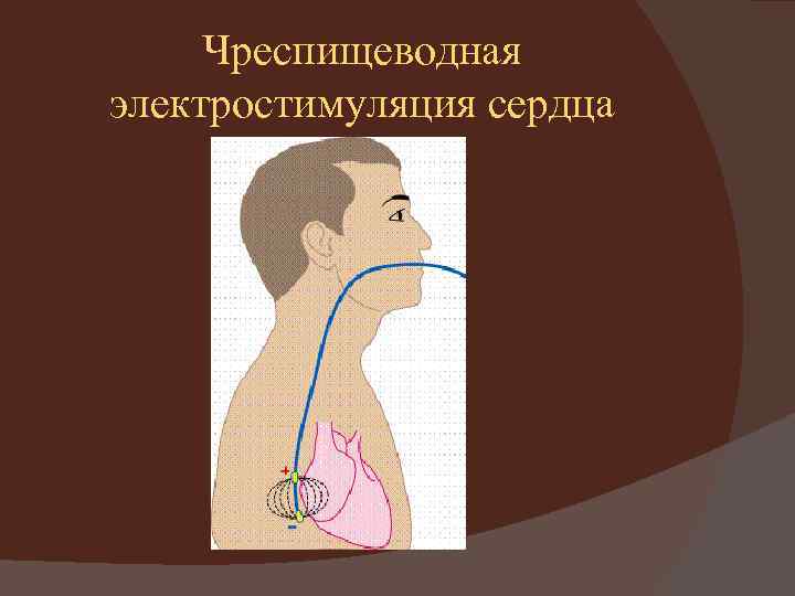 Чреспищеводная электростимуляция сердца 