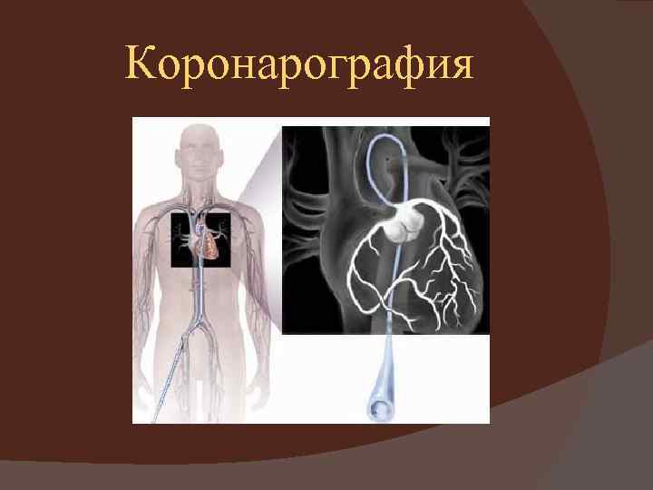 Коронарография 