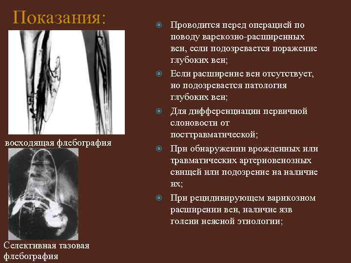 Показания: восходящая флебография Селективная тазовая флебография Проводится перед операцией по поводу варекозно-расширенных вен, если