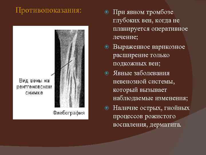 Противопоказания: При явном тромбозе глубоких вен, когда не планируется оперативное лечение; Выраженное варикозное расширение