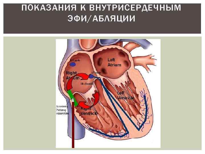ПОКАЗАНИЯ К ВНУТРИСЕРДЕЧНЫМ ЭФИ/АБЛЯЦИИ 