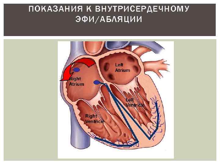 ПОКАЗАНИЯ К ВНУТРИСЕРДЕЧНОМУ ЭФИ/АБЛЯЦИИ 