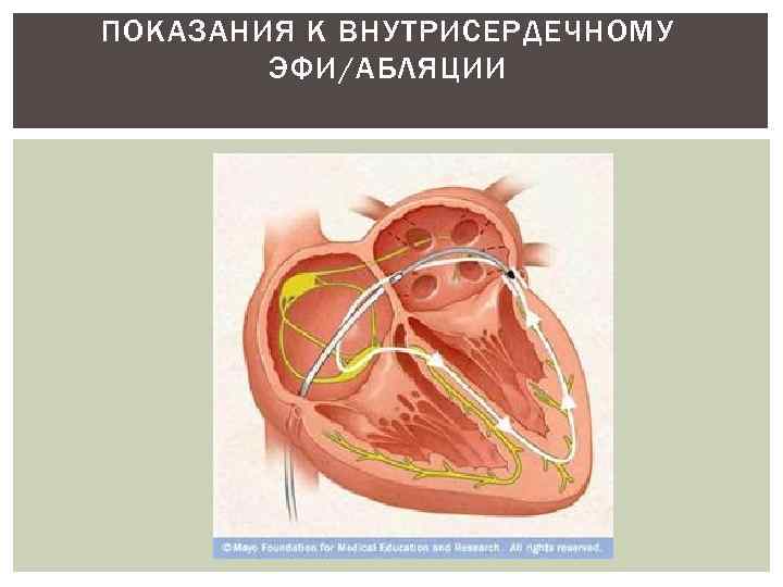 ПОКАЗАНИЯ К ВНУТРИСЕРДЕЧНОМУ ЭФИ/АБЛЯЦИИ 