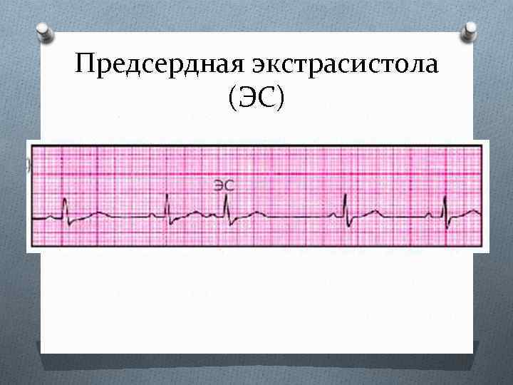 Предсердная экстрасистола (ЭС) 