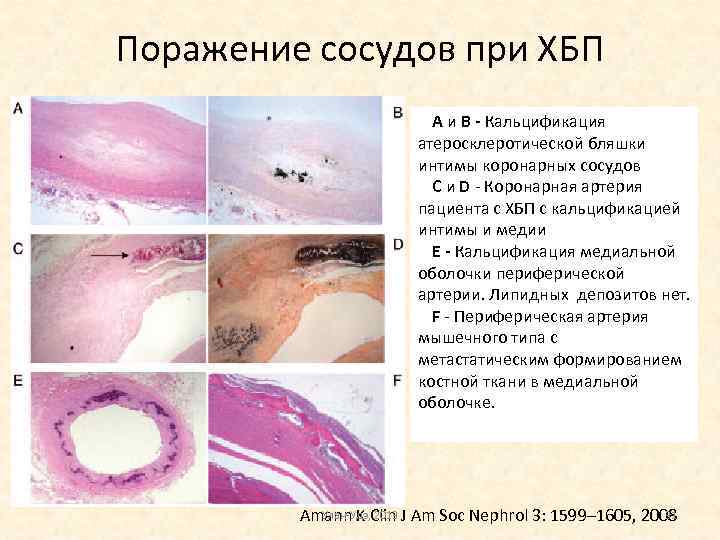 Поражение сосудов при ХБП A и B - Кальцификация атеросклеротической бляшки интимы коронарных сосудов