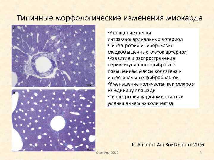 Типичные морфологические изменения миокарда • Утолщение стенки интрамиокардиальных артериол • Гипертрофия и гиперплазия гладкомышечных