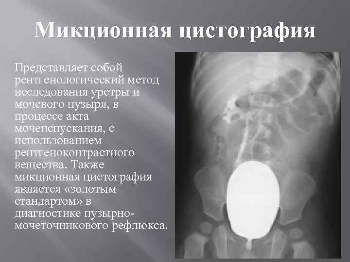 Микционная цистография Представляет собой рентгенологический метод исследования уретры и мочевого пузыря, в процессе акта